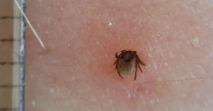 Mammalian Meat Allergy